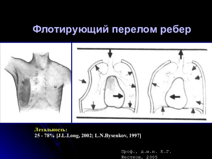 Флотирующий перелом ребер Летальность: 25 - 78% [J.L.Long, 2002; L.N.Bysenkov, 1997] Проф., д.м.н. К.Г.Жестков, 2005