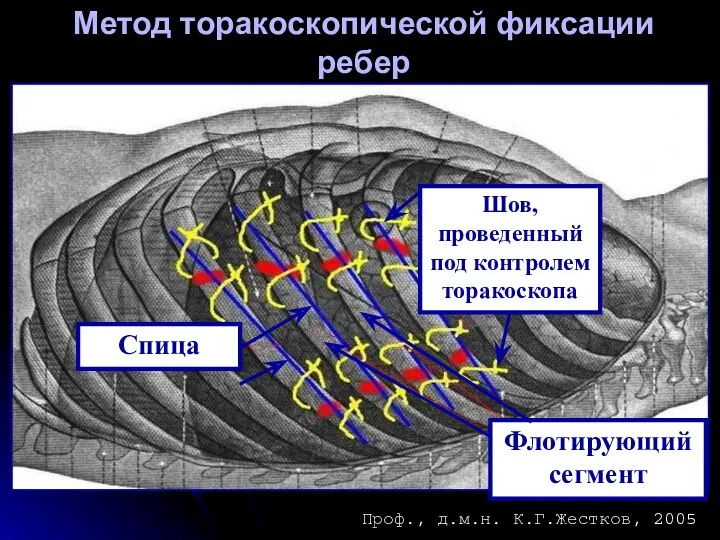 Метод торакоскопической фиксации ребер Шов, проведенный под контролем торакоскопа Флотирующий сегмент Спица Проф., д.м.н. К.Г.Жестков, 2005