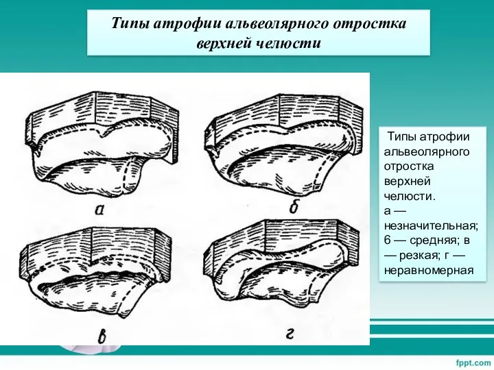 Типы атрофии альвеолярного отростка верхней челюсти Типы атрофии альвеолярного отростка