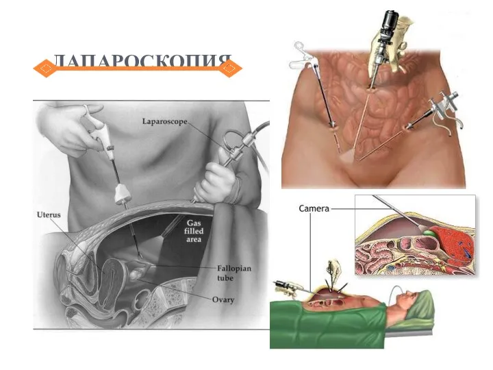 ЛАПАРОСКОПИЯ