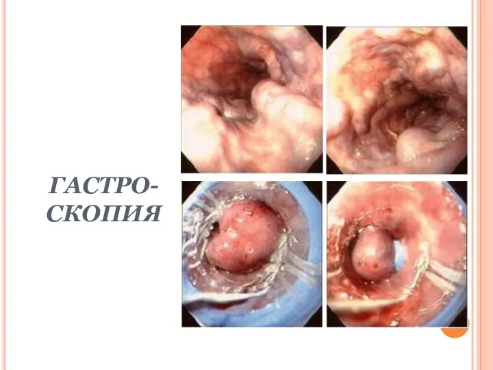 ГАСТРО-СКОПИЯ