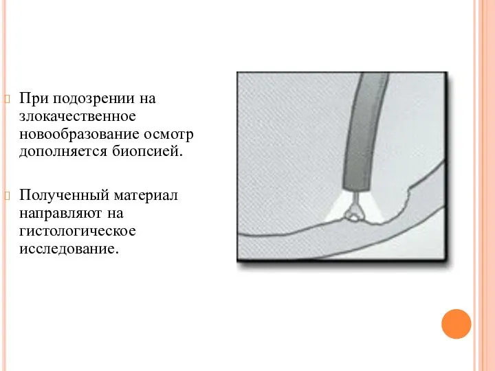 При подозрении на злокачественное новообразование осмотр дополняется биопсией. Полученный материал направляют на гистологическое исследование.