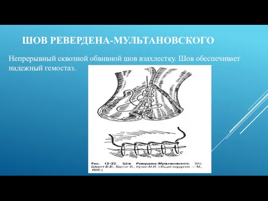 ШОВ РЕВЕРДЕНА-МУЛЬТАНОВСКОГО Непрерывный сквозной обвивной шов взахлестку. Шов обеспечивает надежный гемостаз.