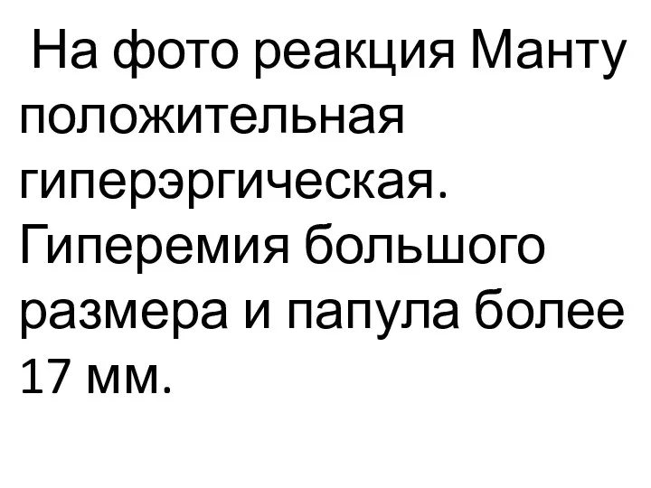 На фото реакция Манту положительная гиперэргическая. Гиперемия большого размера и папула более 17 мм.