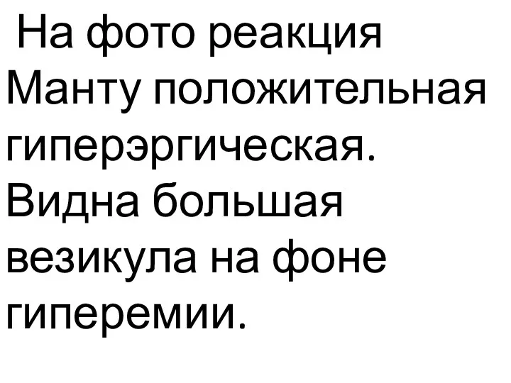 На фото реакция Манту положительная гиперэргическая. Видна большая везикула на фоне гиперемии.