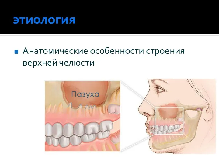 этиология Анатомические особенности строения верхней челюсти