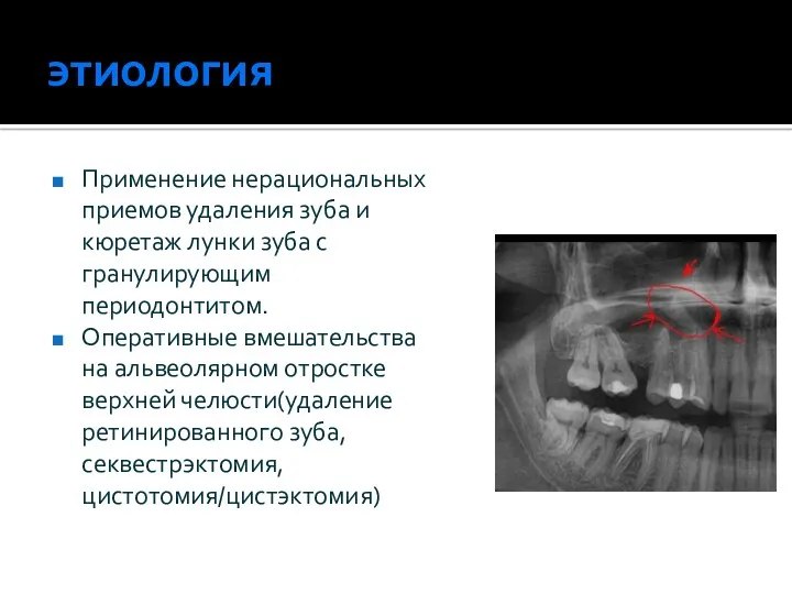 этиология Применение нерациональных приемов удаления зуба и кюретаж лунки зуба