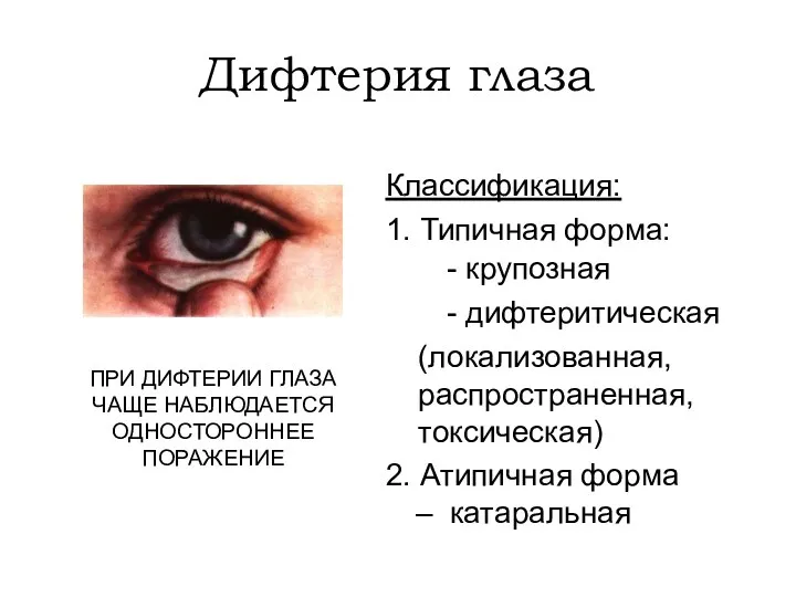 Дифтерия глаза Классификация: 1. Типичная форма: - крупозная - дифтеритическая (локализованная, распространенная, токсическая)