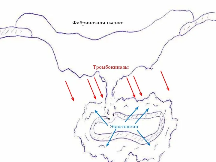 Фибринозная пленка Тромбокиназы Экзотоксин