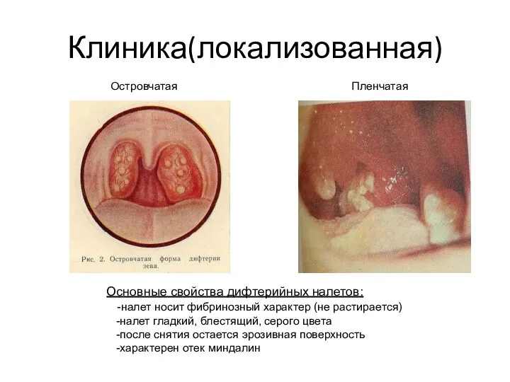 Клиника(локализованная) Островчатая Пленчатая Основные свойства дифтерийных налетов: -налет носит фибринозный характер (не растирается)