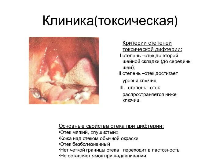 Клиника(токсическая) Критерии степеней токсической дифтерии: степень –отек до второй шейной