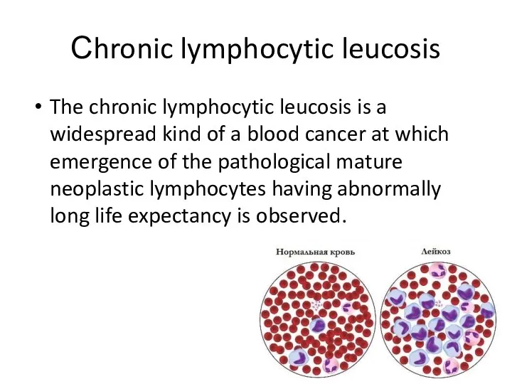 Сhronic lymphocytic leucosis The chronic lymphocytic leucosis is a widespread kind of a