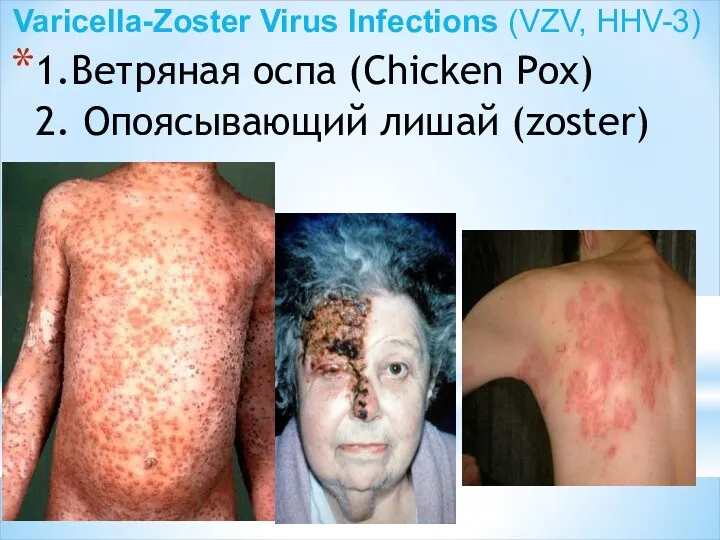 1.Ветряная оспа (Chicken Pox) 2. Опоясывающий лишай (zoster) Varicella-Zoster Virus Infections (VZV, HHV-3)