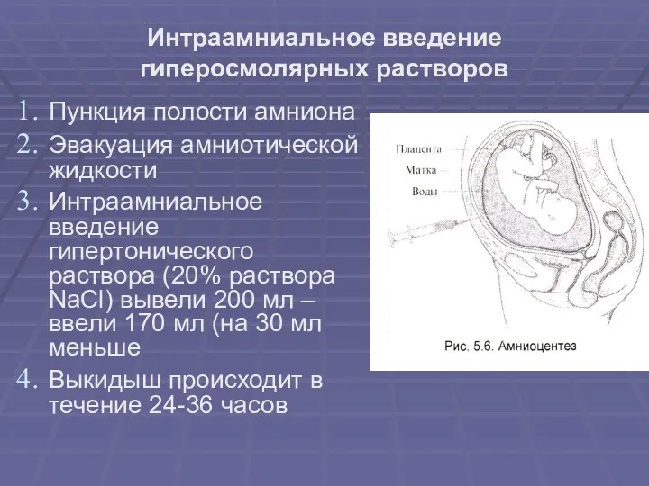 Интраамниальное введение гиперосмолярных растворов Пункция полости амниона Эвакуация амниотической жидкости