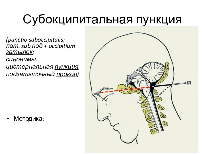 Субокципитальная пункция (punctio suboccipitalis; лат. sub под + occipitium затылок; синонимы: цистернальная пункция, подзатылочный прокол) Методика: