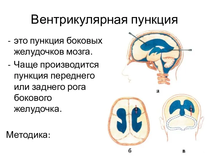 Вентрикулярная пункция это пункция боковых желудочков мозга. Чаще производится пункция