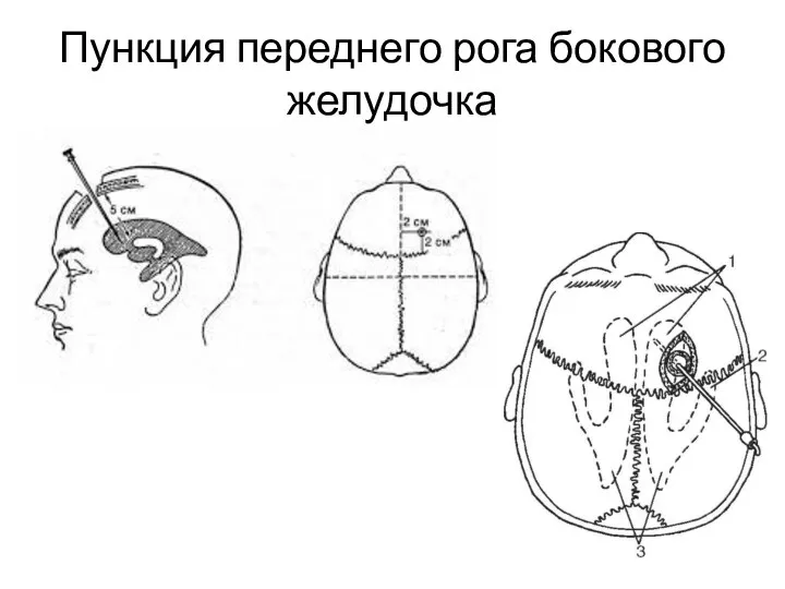 Пункция переднего рога бокового желудочка