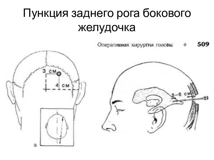 Пункция заднего рога бокового желудочка