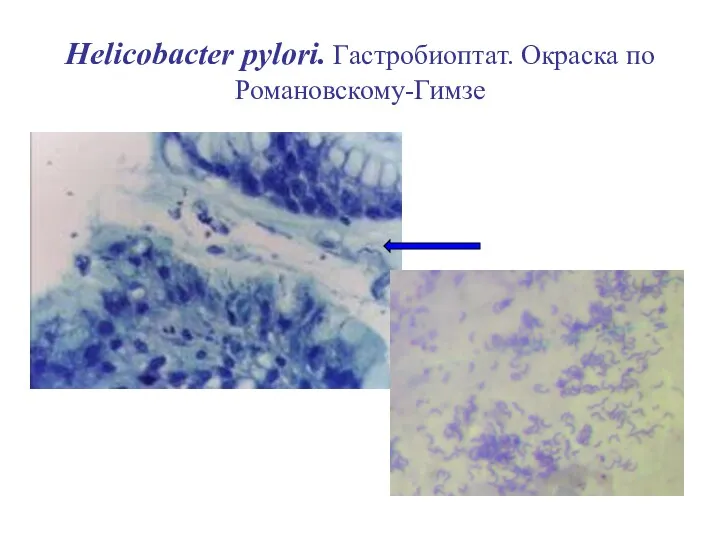 Helicobacter pylori. Гастробиоптат. Окраска по Романовскому-Гимзе