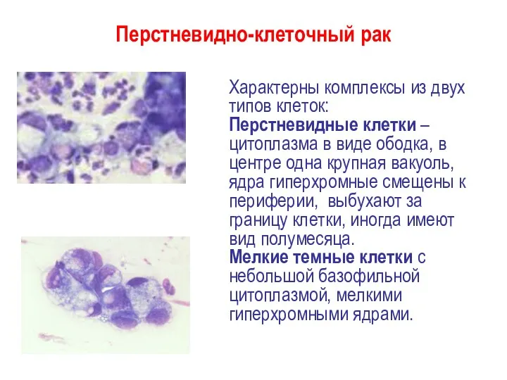 Перстневидно-клеточный рак Характерны комплексы из двух типов клеток: Перстневидные клетки