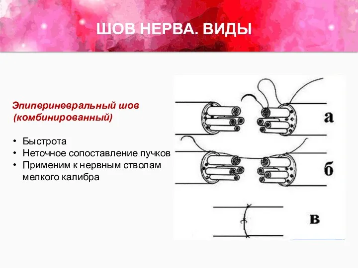 ШОВ НЕРВА. ВИДЫ Эпипериневральный шов (комбинированный) Быстрота Неточное сопоставление пучков Применим к нервным стволам мелкого калибра