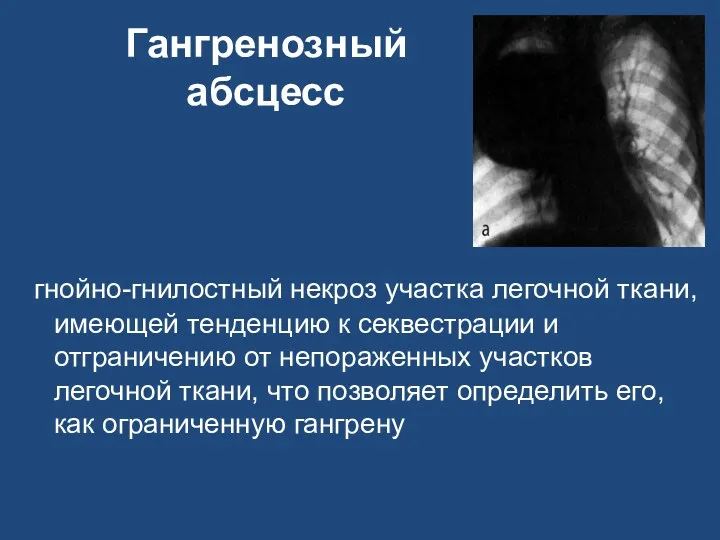 Гангренозный абсцесс гнойно-гнилостный некроз участка легочной ткани, имеющей тенденцию к