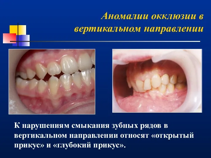 Аномалии окклюзии в вертикальном направлении К нарушениям смыкания зубных рядов