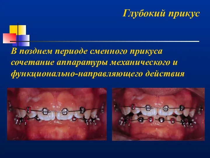 Глубокий прикус В позднем периоде сменного прикуса сочетание аппаратуры механического и функционально-направляющего действия