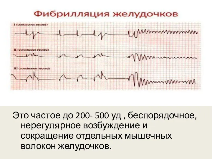 Это частое до 200- 500 уд , беспорядочное, нерегулярное возбуждение и сокращение отдельных мышечных волокон желудочков.