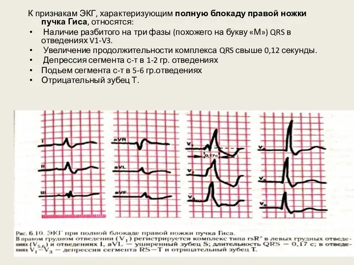 К признакам ЭКГ, характеризующим полную блокаду правой ножки пучка Гиса,