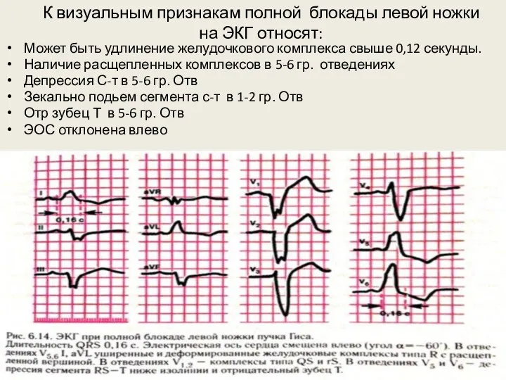 К визуальным признакам полной блокады левой ножки на ЭКГ относят: