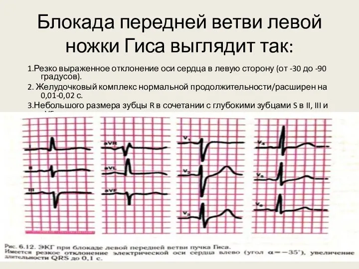 Блокада передней ветви левой ножки Гиса выглядит так: 1.Резко выраженное