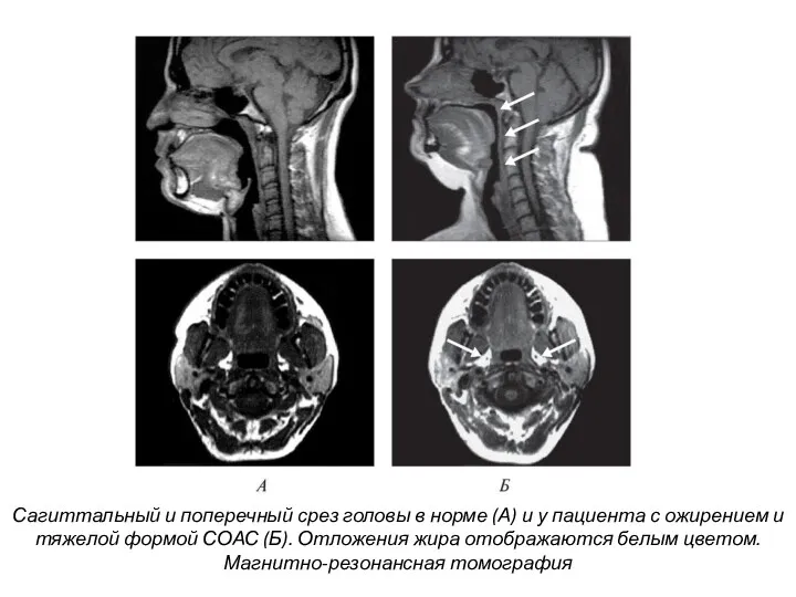 Сагиттальный и поперечный срез головы в норме (А) и у