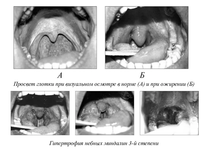 Просвет глотки при визуальном осмотре в норме (А) и при