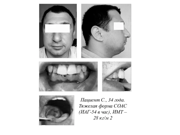 Пациент С., 34 года. Тяжелая форма СОАС (ИАГ-54 в час), ИМТ – 28 кг/м 2