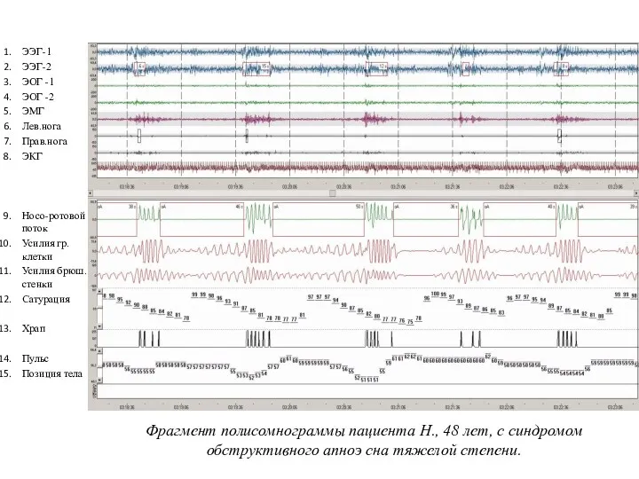 ЭЭГ-1 ЭЭГ-2 ЭОГ -1 ЭОГ -2 ЭМГ Лев.нога Прав.нога ЭКГ