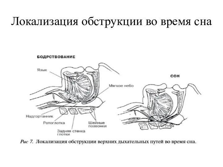 Локализация обструкции во время сна