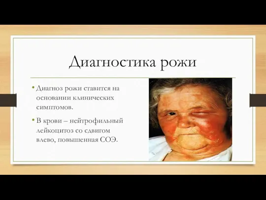 Диагностика рожи Диагноз рожи ставится на основании клинических симптомов. В