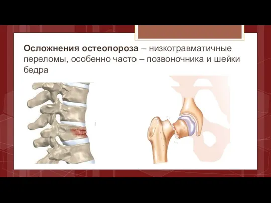 Осложнения остеопороза – низкотравматичные переломы, особенно часто – позвоночника и шейки бедра
