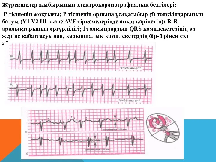 Жүрекшелер жыбырының электрокардиографиялык белгілері: Р тісшенің жоқтығы; Р тісшенің орнына