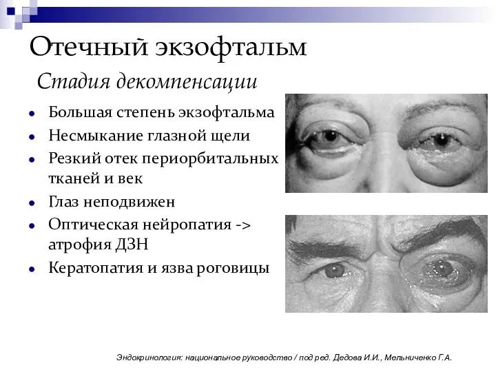 Отечный экзофтальм Стадия декомпенсации Большая степень экзофтальма Несмыкание глазной щели