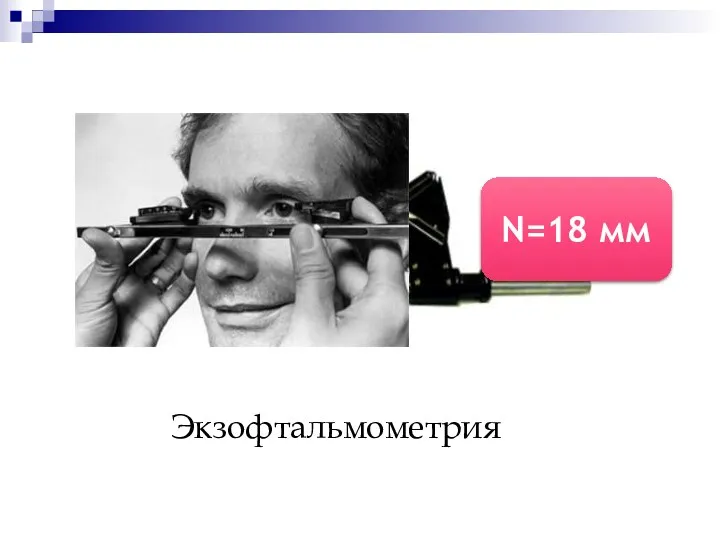 Экзофтальмометрия N=18 мм