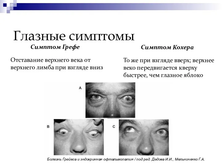 Глазные симптомы Симптом Грефе Отставание верхнего века от верхнего лимба