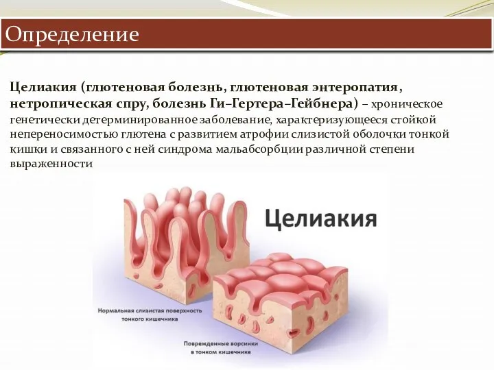 Определение Целиакия (глютеновая болезнь, глютеновая энтеропатия, нетропическая спру, болезнь Ги–Гертера–Гейбнера)