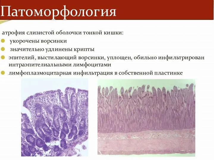 Патоморфология атрофия слизистой оболочки тонкой кишки: укорочены ворсинки значительно удлинены