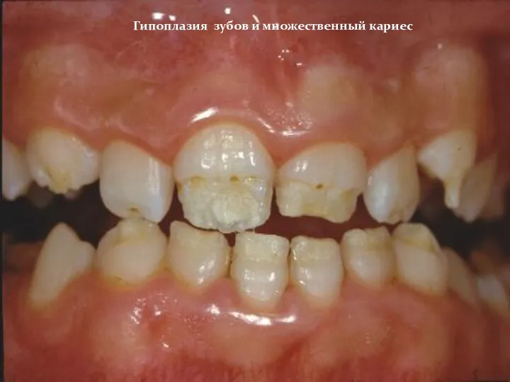Гипоплазия зубов и множественный кариес
