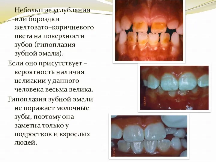 Aine et al. 90 Небольшие углубления или бороздки желтовато–коричневого цвета на поверхности зубов