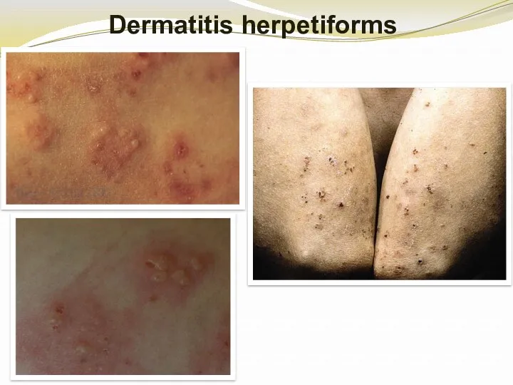 Dermatitis herpetiforms
