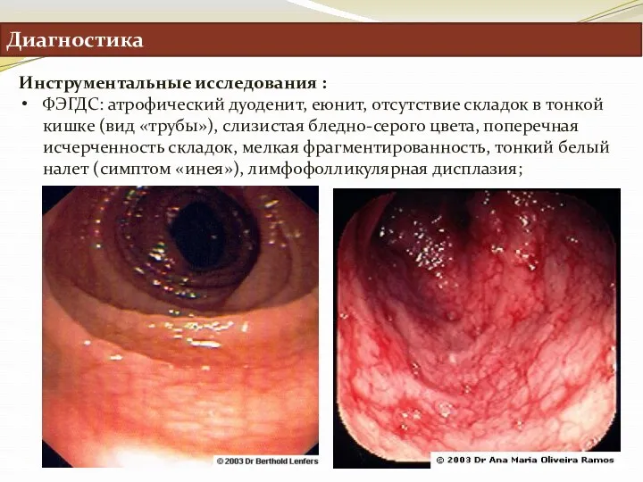 Диагностика Инструментальные исследования : ФЭГДС: атрофический дуоденит, еюнит, отсутствие складок