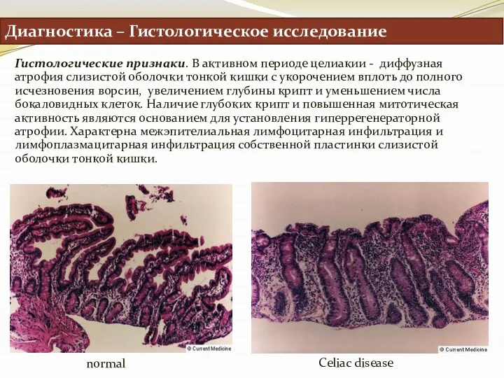 Диагностика – Гистологическое исследование Гистологические признаки. В активном периоде целиакии